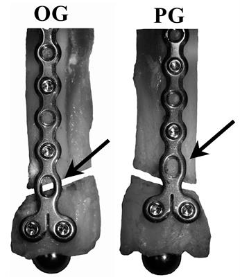 Open Screw Placement in a 1.5 mm LCP Over a Fracture Gap Decreases Fatigue Life
